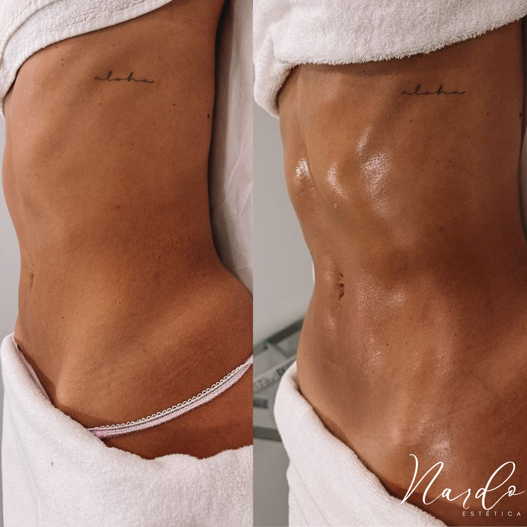 Lipoescultura Drenaje Linfático De Abdomen Masajes